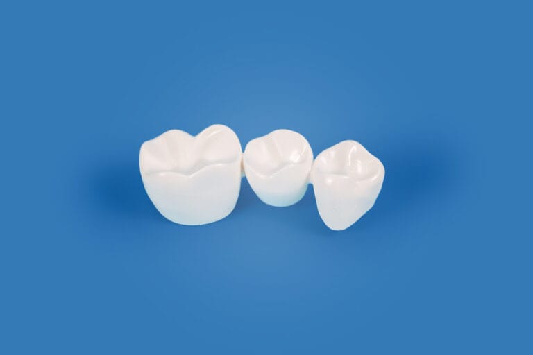 Dental Crowns & Bridges, North Vancouver