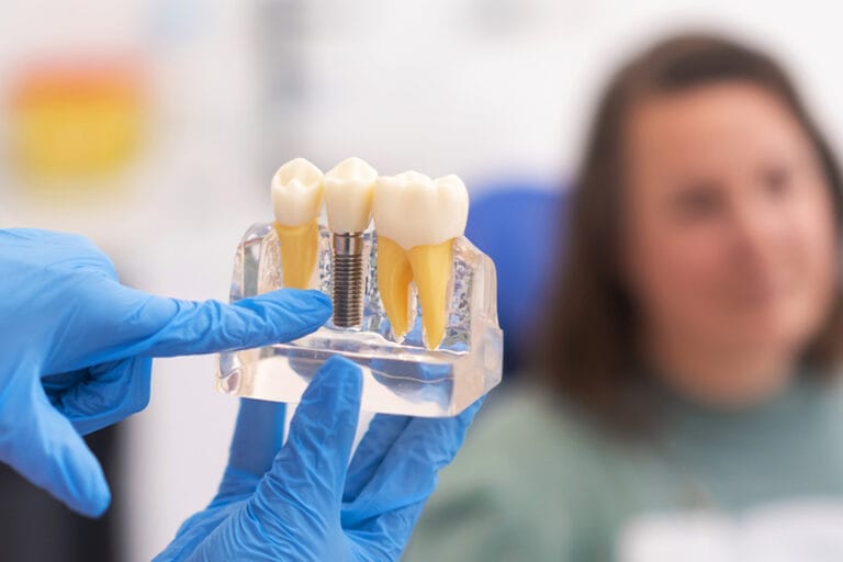 Dental Implants, North Vancouver