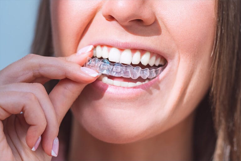 Invisalign, North Vancouver