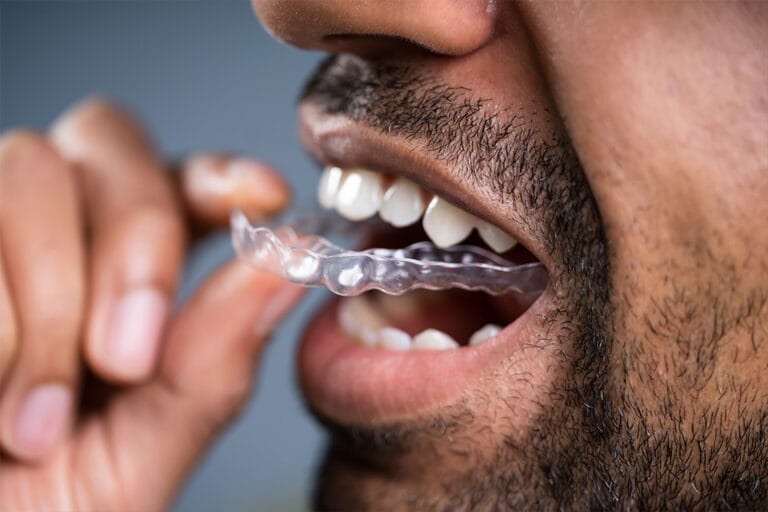 Mouthguards & Bruxism Treatment, North Vancouver