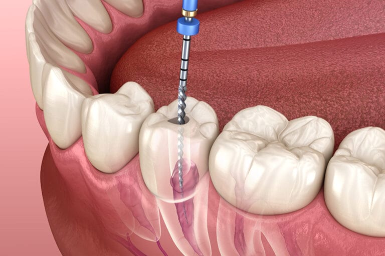Root Canal Treatment, North Vancouver