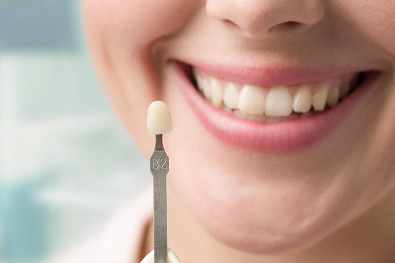 Veneers & Bonding, North Vancouver